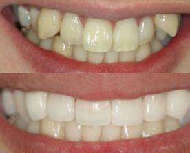 矫正虎牙的误区