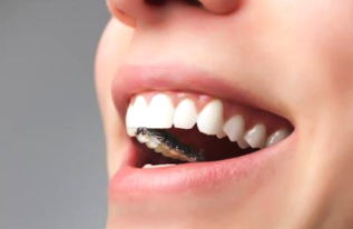 虎牙应如何矫正