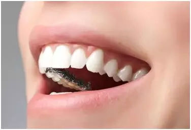 哪些患者适合做隐形正畸？