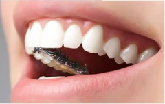 牙齿不齐的危害及矫正方法