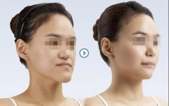 牙齿矫正的最佳年龄是什么时候