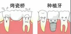 天津烤瓷牙和种植牙哪个好？