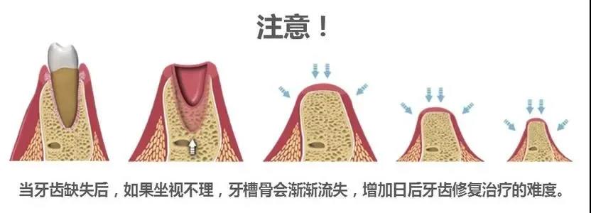 牙医为何一致推荐种植牙？