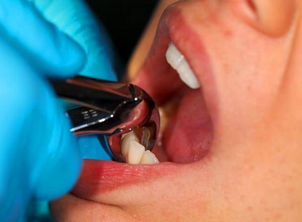 拔牙要上午，不能下午，为什么？