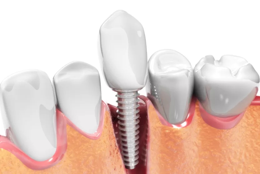 哪些情况下适合做半口种植牙?