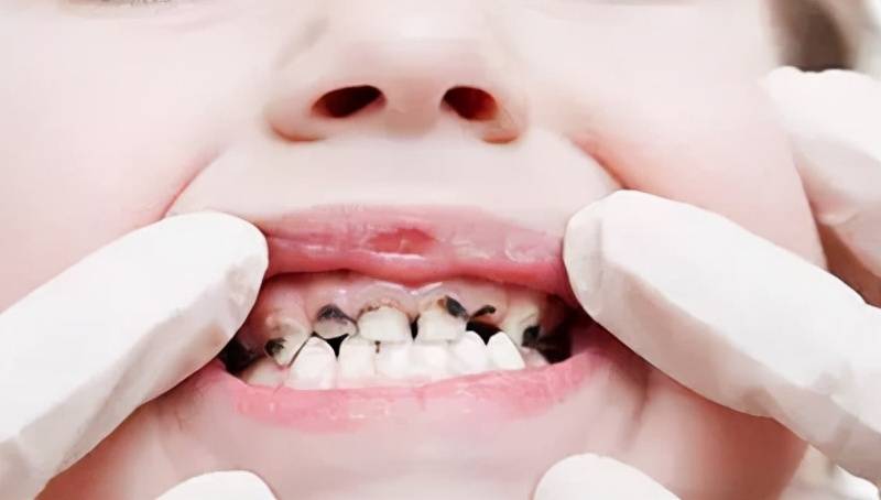 乳牙龋坏不重视，恒牙也遭殃！