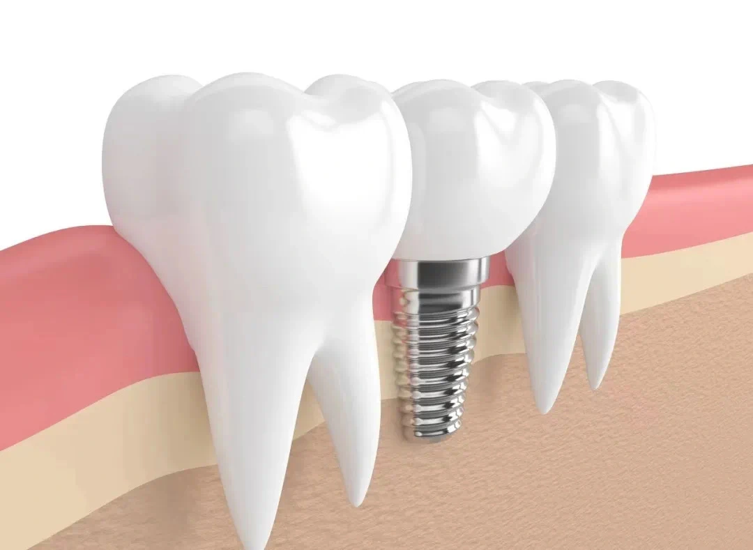 种植牙真的是种出&ldquo;真牙&rdquo;来的吗？