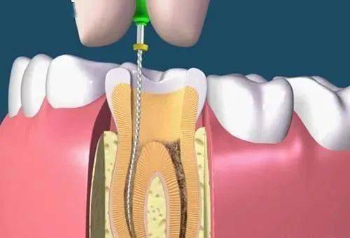 根管治疗后不做冠，牙齿早晚留后患