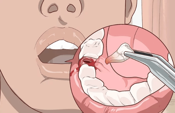 你知道拔牙后为什么不能吐口水吗？