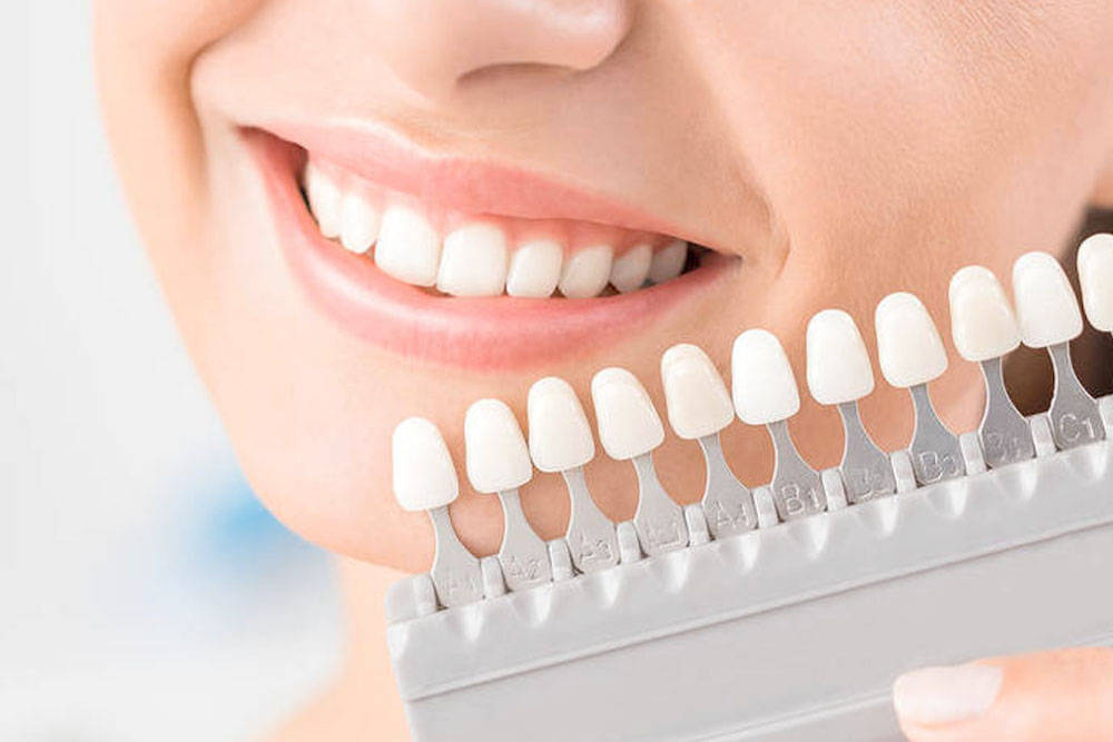 对于牙贴面，你了解多少？