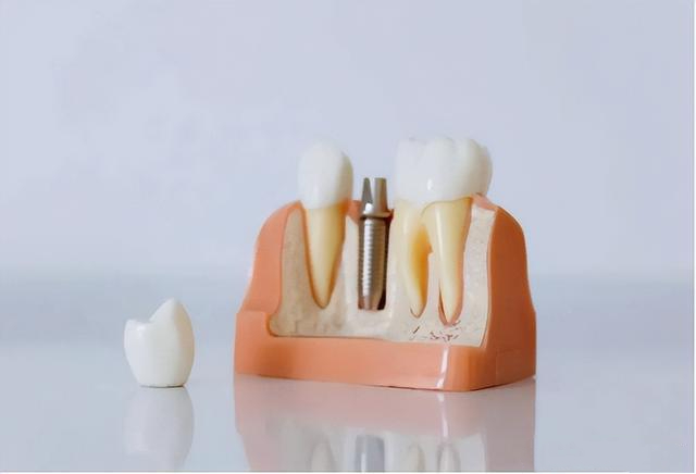 缺了那么长时间的牙，还有必要种植吗？