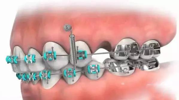 正畸中的骨钉是什么？