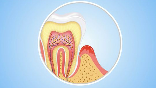 牙周炎不治疗，会导致怎样可怕的结果
